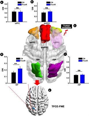 Structural and Functional Reorganization Within Cognitive Control Network Associated With Protection of Executive Function in Patients With Unilateral Frontal Gliomas